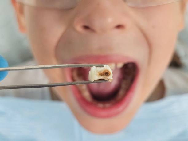 Best Emergency Treatment for Oral Infections in Carrollton, AL