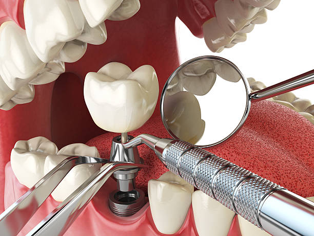 Best Emergency Wisdom Tooth Extraction in Carrollton, AL